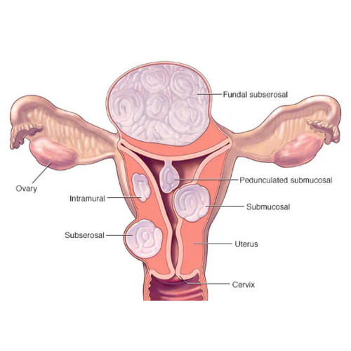 Referral Centre for Fibroid Patient
